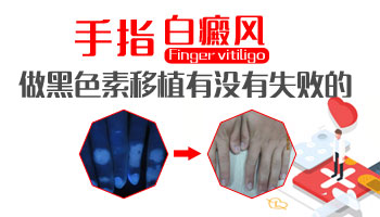 手指白癜风皮肤移植的效果