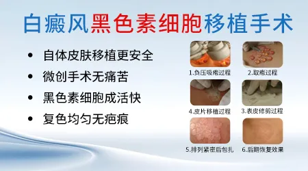 白癜风面积超过10%还能做手术吗