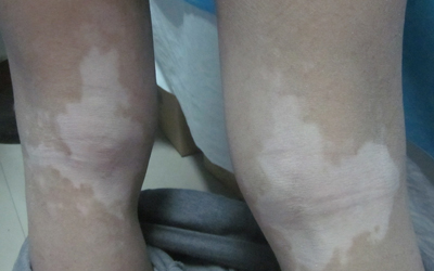 女性大腿根部白癜风图片