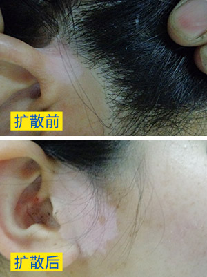 孕期白癜风有白癜风扩散的征兆