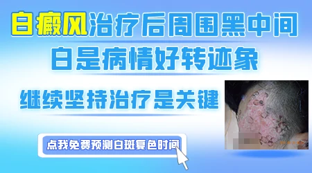 中医能把十几年的老白斑治好吗