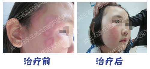 脸部早期白癜风照308可以完全复色吗