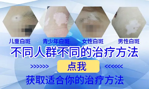 孕妇腿上长白癜风怎么办