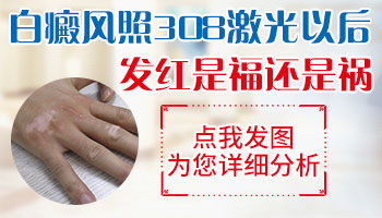 白癜风光疗为什么会发红