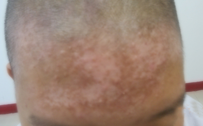 新生儿额头有几块白色的地方