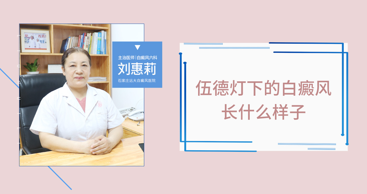 伍德灯下的白癜风长什么样子