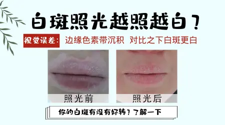 白斑照光越照越白