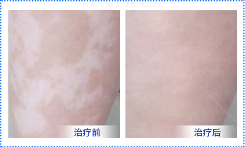 膝盖上突然白了一大片怎么回事