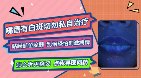 嘴唇白癜风怎么治疗 黏膜部位用药