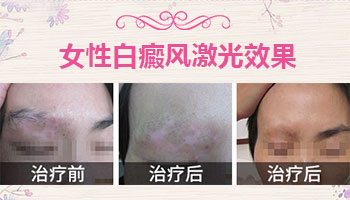 308激光治疗白癜风一个疗程是多少次