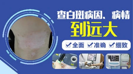 白癜风需要做什么检查能查出病因