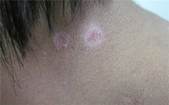 小孩身上起小白点的图片