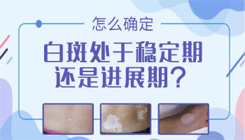 白癜风多久不出新白斑代表病情稳定