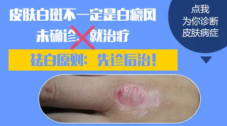 孩子皮肤出现白斑一定是白癜风吗