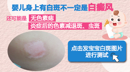 婴儿正常白斑图片 婴儿白癜风症状