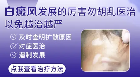 进展期白癜风适合哪种方法治疗