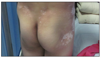 臀部很多小白点是什么