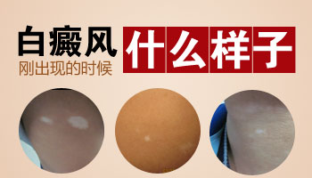 白癜风新发白斑是什么样子的