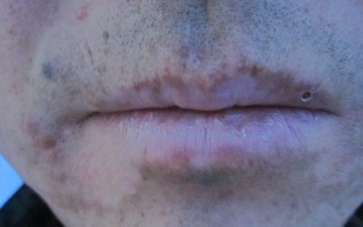 唇癌白斑图片