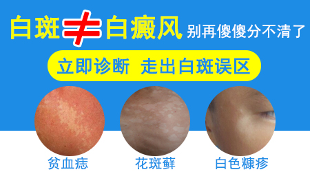 白癜风和白色糠疹怎么区分
