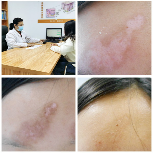 白癜风用激光照了之后会出现什么症状