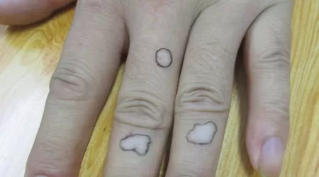 白癜风手指关节照片