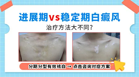稳定期和进展期白癜风光疗有区别吗