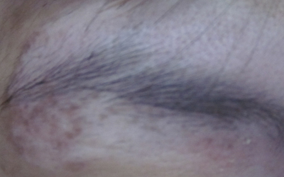 30岁女性眉毛上边的白斑两个月了有扩散趋势