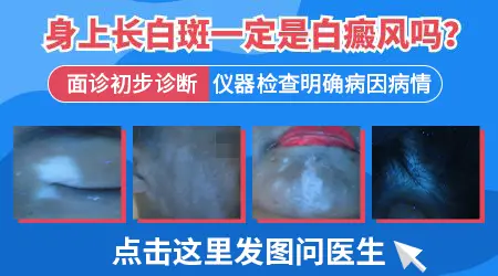 浅浅的白斑点是不是白癜风