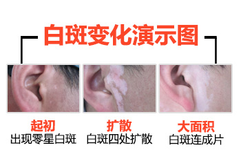 感觉白斑处变大了是扩散了吗