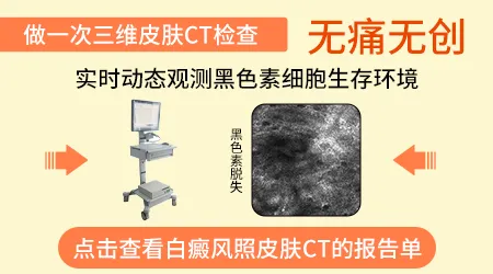 皮肤CT检查白斑的费用是多少