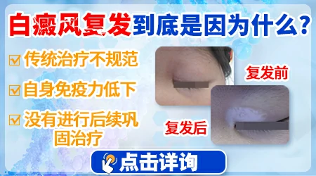 顽固性白斑能治好吗 白斑反复的原因