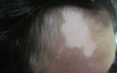 额头上有块皮肤突然变白怎么回事