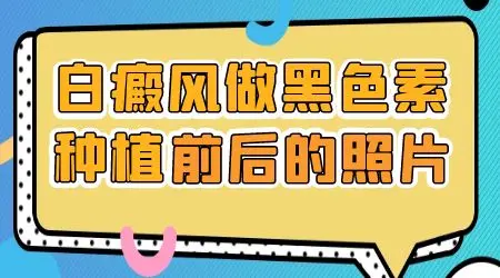 白斑表皮移植十天后的样子