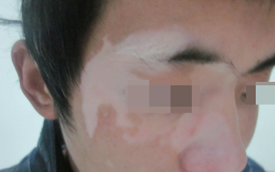 青少年脸上有白斑图片 孩子脸上白斑是白癜风吗