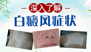 白癜风一般是长一边还是对应的两边都会长