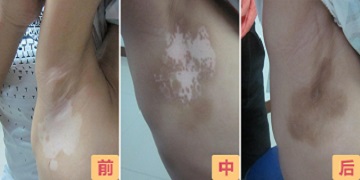白癜风色素岛形成了到完全好需多长时间