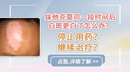 白斑涂抹他克莫司后更白是怎么回事