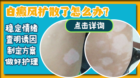 白癜风扩散了该怎么办
