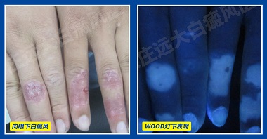 皮肤受伤结痂后变白皮肤是白癜风吗