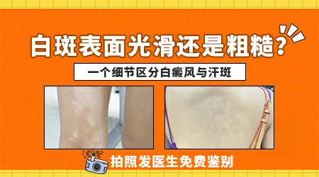 汗斑和白癜风外观上有什么区别图片