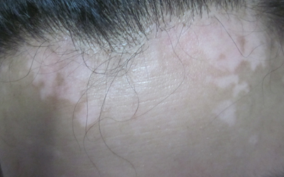 婴儿额头一大片白斑正常图片