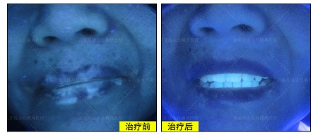 隐形白癜风照美国308容易消退吗