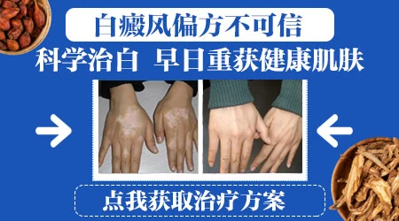 白癜风有什么外敷的偏方吗