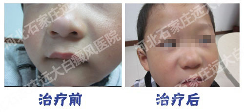 1岁宝宝脸上长白斑原因
