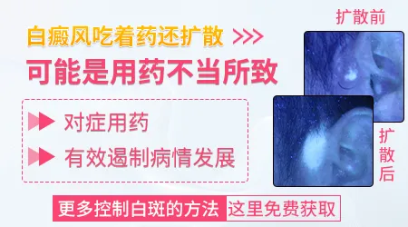 治疗期间白斑扩散是正常现象吗