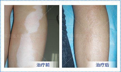 能不能在家自己用光疗机照白癜风