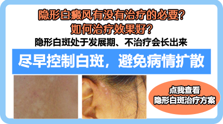 吃药隐形白癜风能下去吗