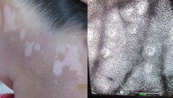 脸部早期白癜风症状图片是什么样