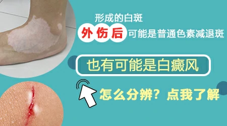外伤引起的白斑能不能自愈